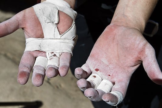 Climber's hands showing calluses and tape, one with a flapper injury, highlighting the physical toll of climbing and the need for proper hand care.